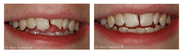 Child Fractured tooth- Before and After composite Bonding-1