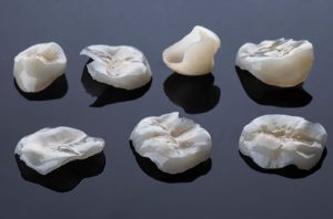 Ceramic-porcelain-Inlays-and-Onlays-2