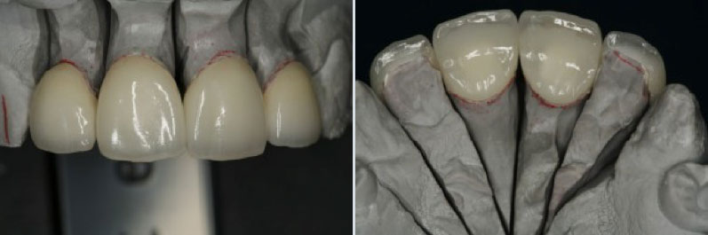 The-frontal-and-palatal-views-of-the-ceramic-porcelain-crowns