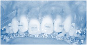 Accelerated Orthodontics London