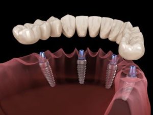 All-on-4per6-Unit-Implants