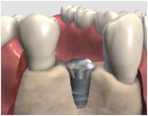 Bone Augmentation London