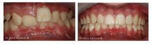 Invisalign Case Studies