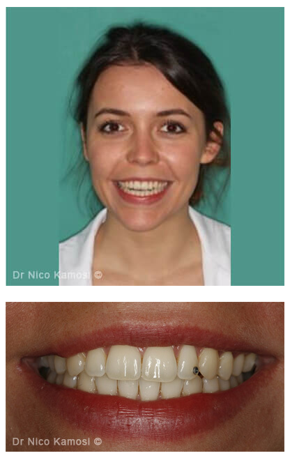 Case Studies Orthodontics and Invisalign London