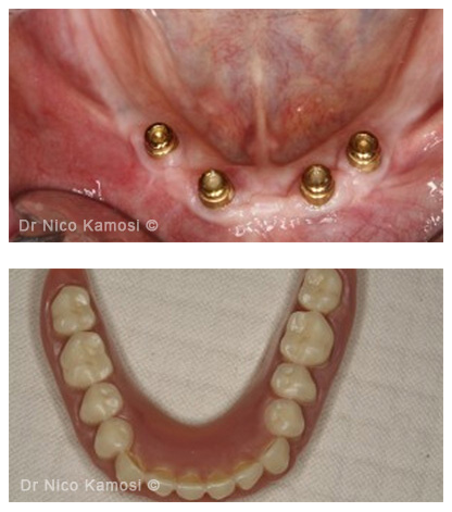 Case Studies Dental Implants