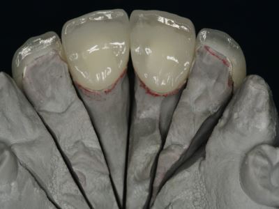 Ceramic Dental Restoration London
