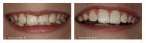 Composite Bonding London