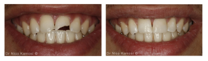 Composite Bonding London