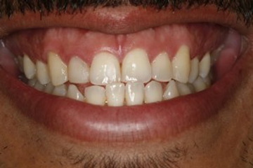 Excessive Gingival Display Dental Treatments London