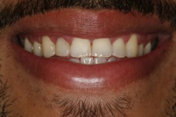 Excessive Gingival Display or Gummy Smile Dental Treatments London