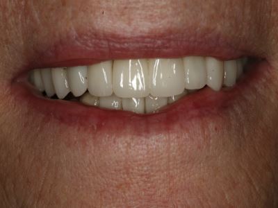 Full Mouth Rehabilitation Dental Treatments London