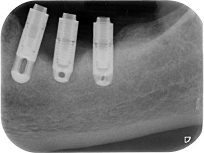 Peri-Implantitis Dental Treatments London
