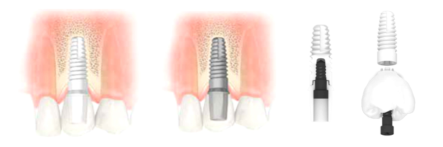 White Dental Implants London