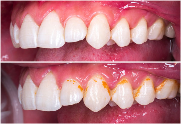 Dental-Stain-removal-before-after-London-Specialist-Dentists