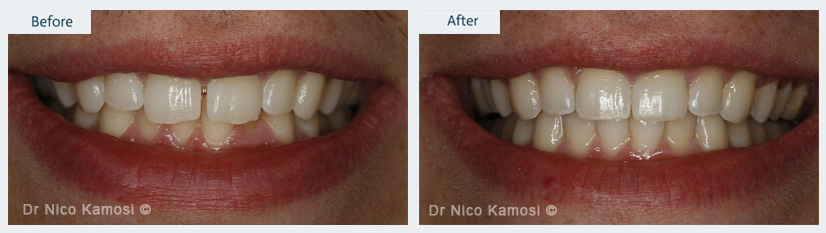 invisalign-before-after-example-1