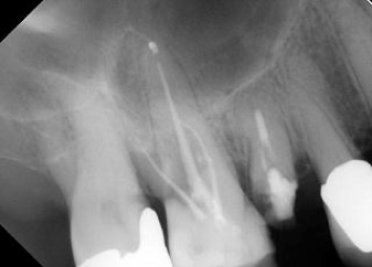 oral-surgery-inner-page-Bone-augmentation