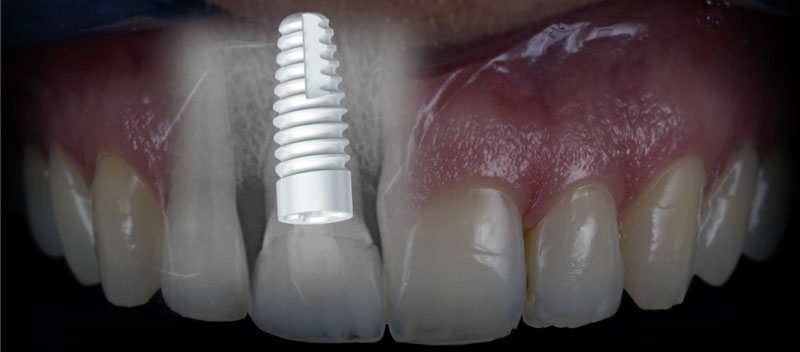 Ceramic-Non-Metal-Dental-Implants