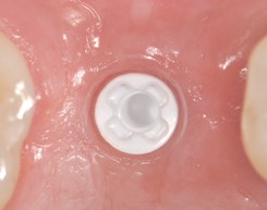 Holistic-Dental-Implant-Ceramic-Implant-base