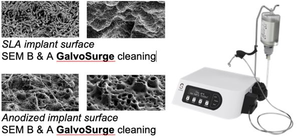 Implant Surfaces Cleaning-Implant failures and complications