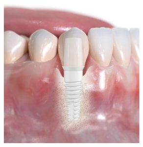 Zirconia-white-ceramic-dental-implants