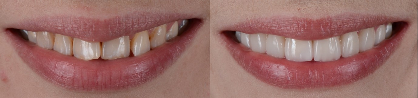 gum-disease-treatment-before-after