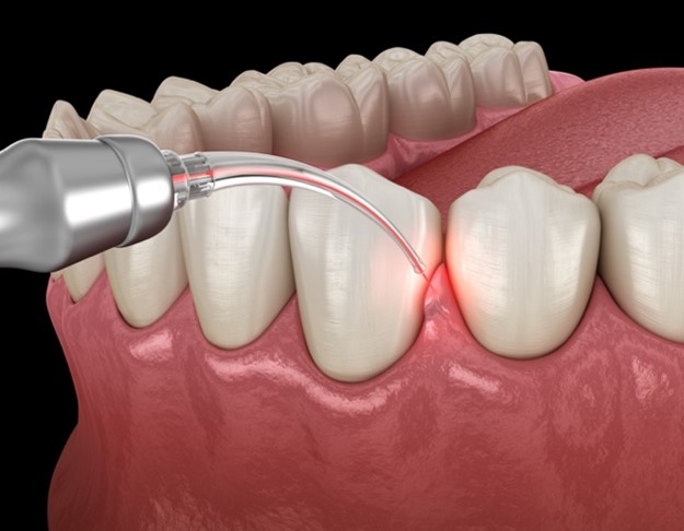 gum-disease-treatment-laser-periodontal-therapy