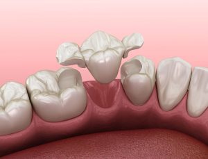 Types-of-Crown-and-bridge-London-Specialist-Dentists