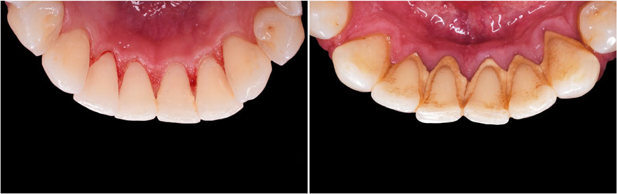 causes-of-periodontal-gum-disease
