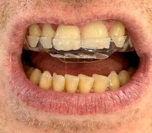 Michigan Splint