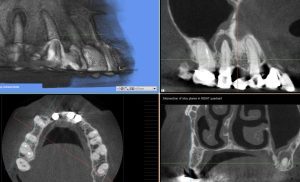 Root Canal Treatment