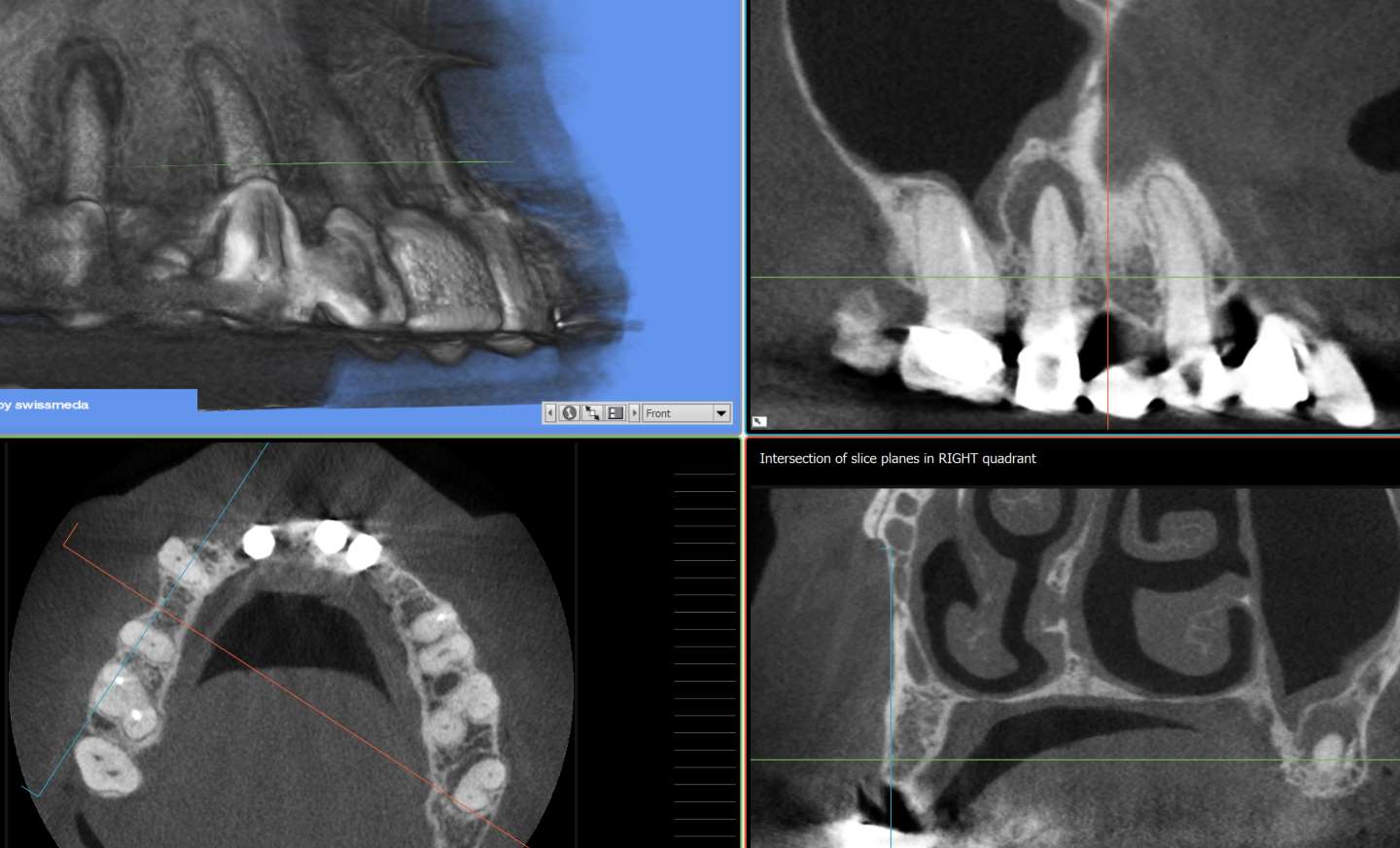 root-canal-treatment-and-cost-moorehead-dentistry