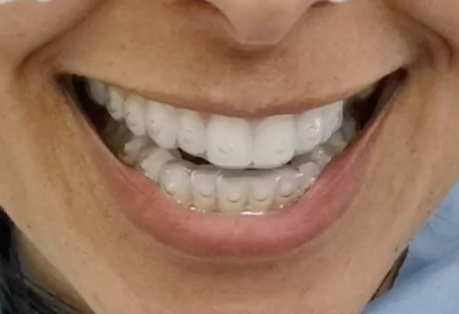 Teeth Whitening techniques
