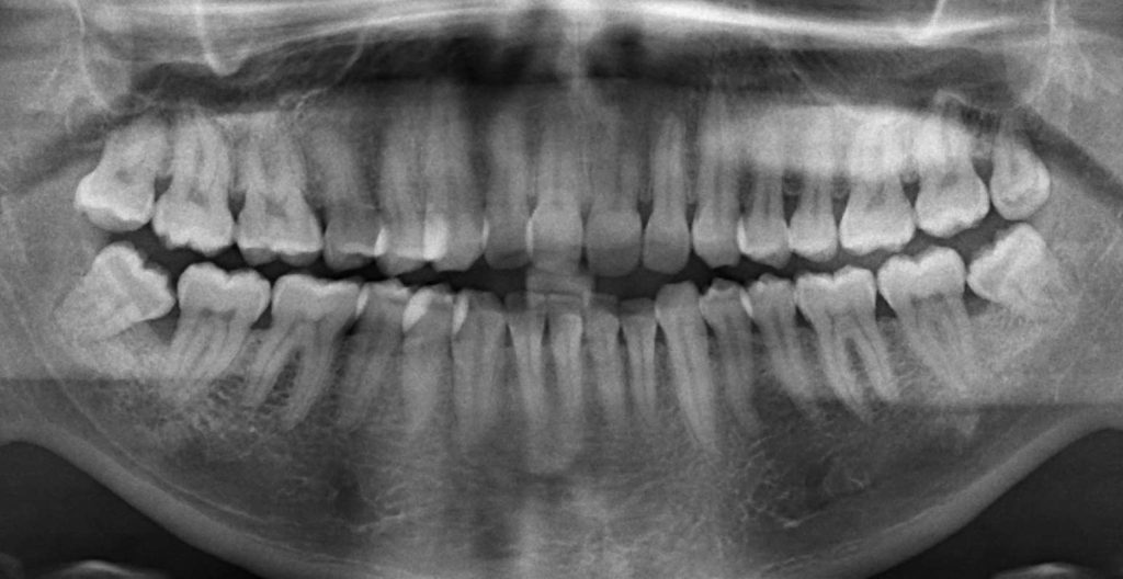 Wisdom Teeth Extraction- x-ray