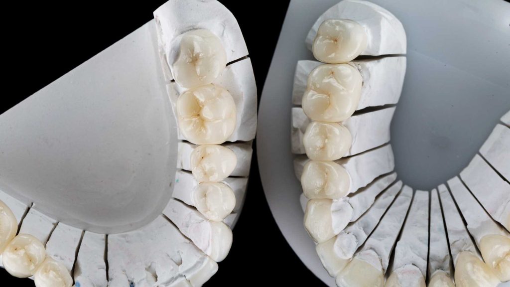 What are the different types of Crowns and Bridges