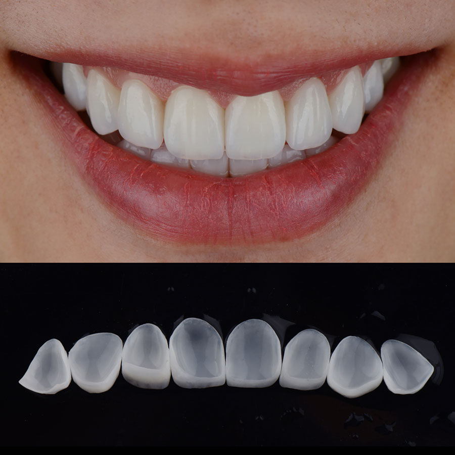 Ceramic-Veneers-London-Specialist-Dentists