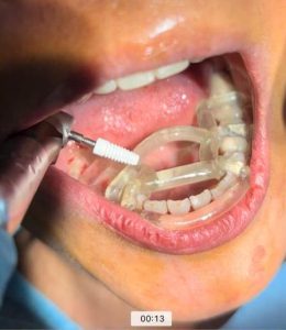Ceramic implant