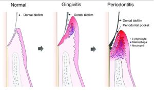 Gum health