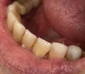 The Convergence of Composite Bonding and Holistic Dentistry