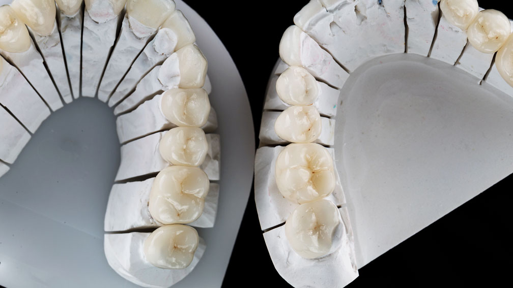The-Art-and-Science-Behind-Dental-Bridges-and-Crowns