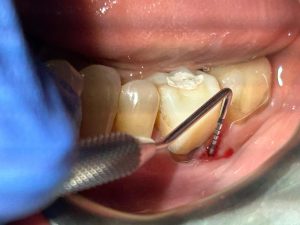 The Intricate Link between Periodontal Disease and Systemic Inflammatory Conditions