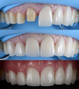 ceramic crowns and bridges
