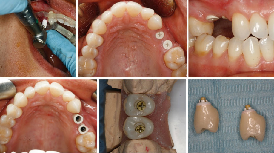Zirconia-ceramic-dental-implant