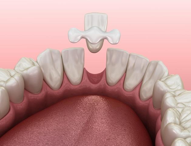 Maryland Dental Bridge - image2