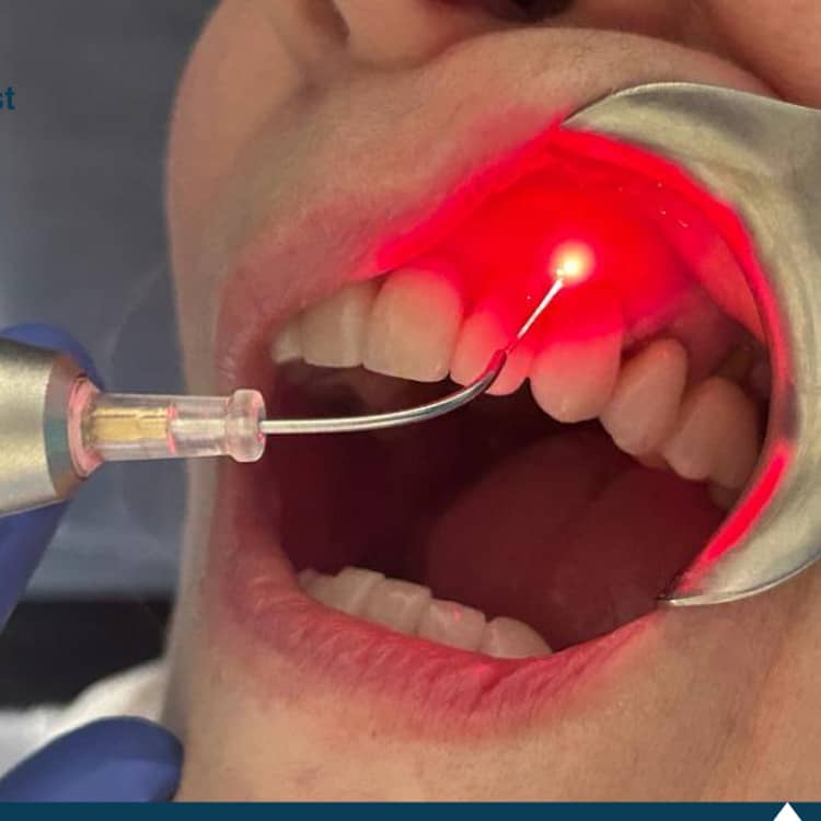 Laser-Assisted-Periodontal-Therapy-LAPT