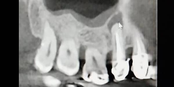 See the 2D-radiograph above - Peri-apical Granuloma caused by inadequate leaking root canal treatment