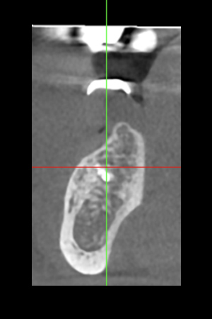 See the 3D frontal view below the radiopaque lesions