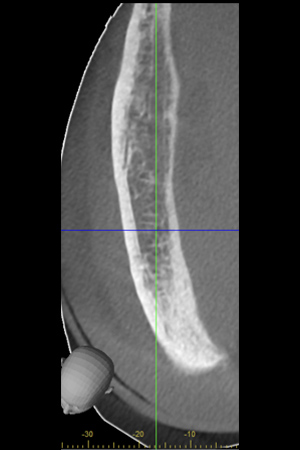 See-the-3D-top-axial-view radiolucent lesions