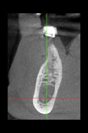 see the front view below the radiolucent lesion