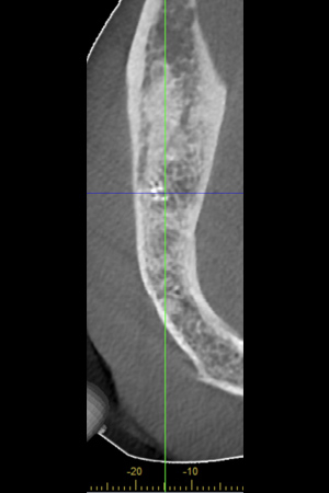 see the top axiel view radiopaque lesion