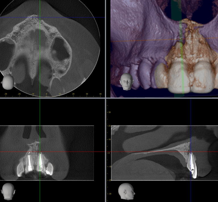 Root Canal Infections and Their Link to Autoimmune Diseases: A Case ...